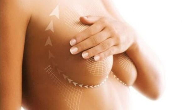 Nahtlift zur Brustvergrößerung