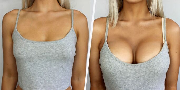 vor und nach plastischer Chirurgie zur Brustvergrößerung