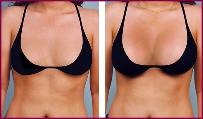 vor und nach Brustvergrößerung mit Fett