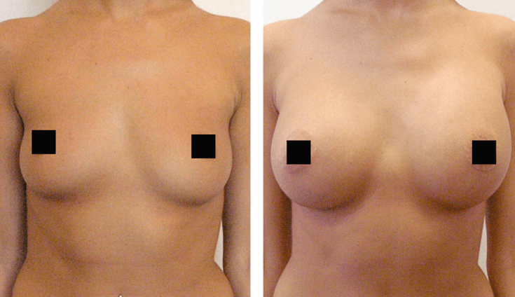 Brüste vor und nach der Vergrößerung mit Hyaluronsäure