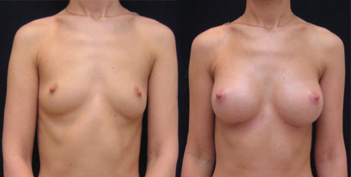 Brust vor und nach endoskopischer Augmentation