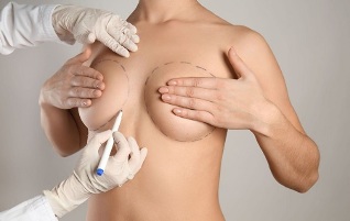Methoden der Brustvergrößerung mit Operation