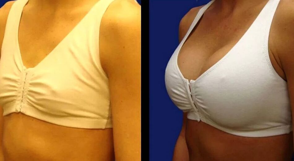 Brustfoto vor und nach der Operation