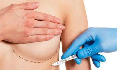 Submammatikarischer Zugang zur Brustvergrößerung mit Implantaten