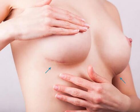 Brustvergrößerung mit Implantaten