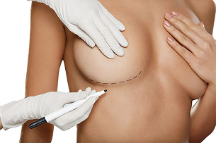 Markierung mit einem Marker vor der Brustvergrößerung